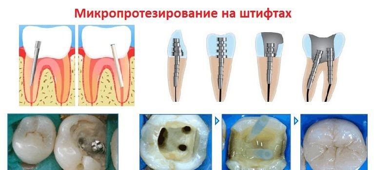 Микропротезирование на штифтах