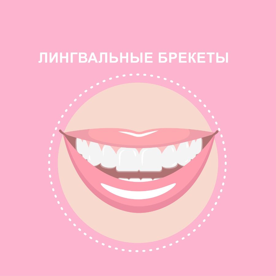 Лингвальные внутренние брекеты - невидимые, невидимки, виды брекетов