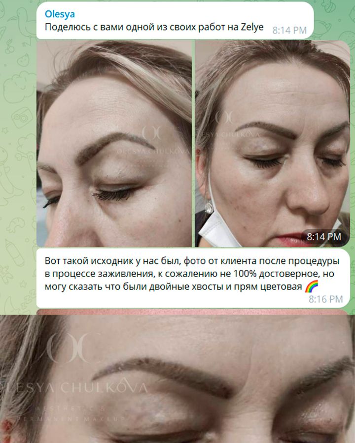 Как клиенты влияют на результат удаления татуажа ремувером и лазером?