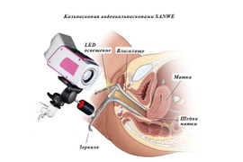 Видеокольпоскопия