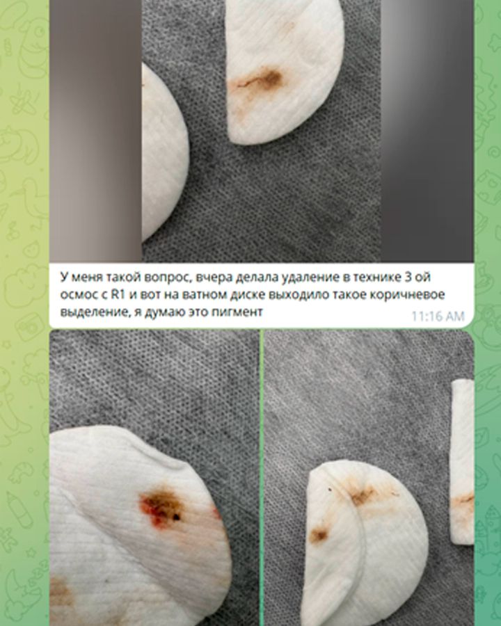 ВЫХОДИТ ЛИ ПИГМЕНТ ИЗ КОЖИ ВО ВРЕМЯ РАБОТЫ РЕМУВЕРОМ? ИЛИ ЭТО ЛОЖЬ?