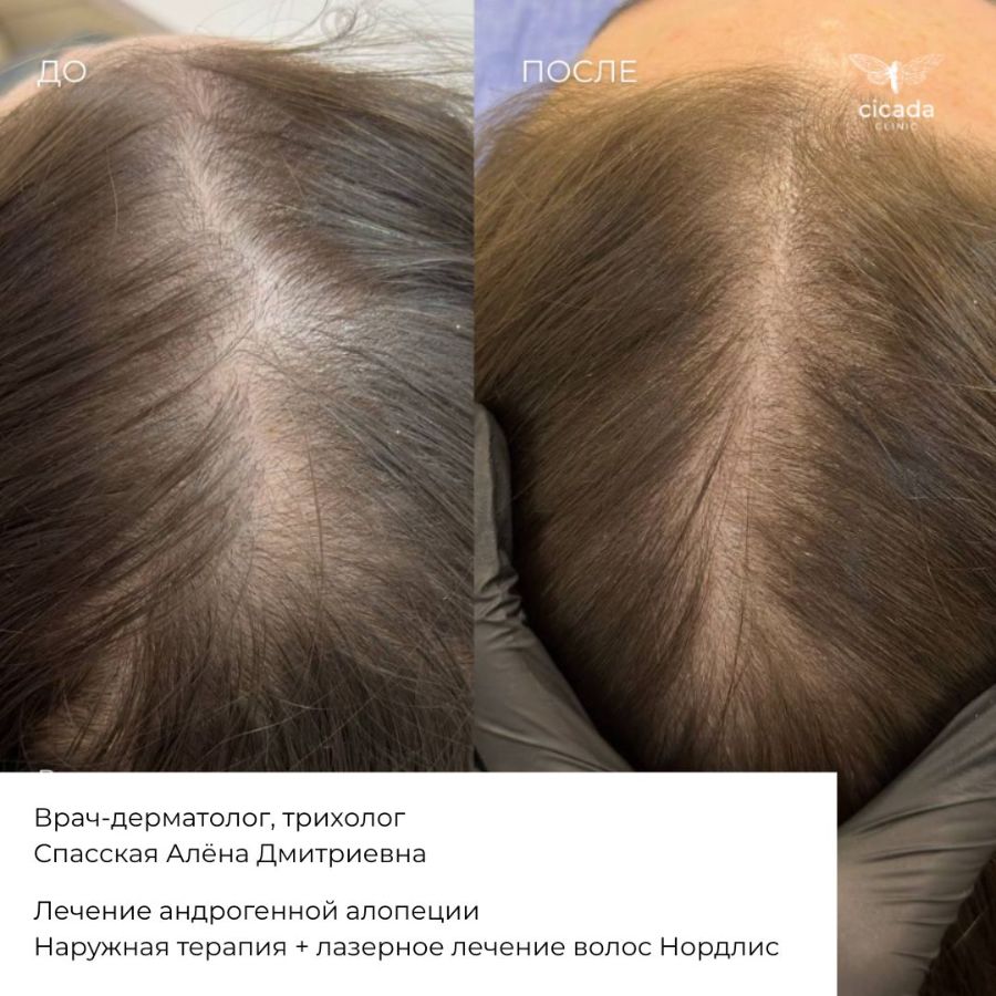 Результат процедуры - Мезотерапия волосистой части головы Cicada Clinic в Твери