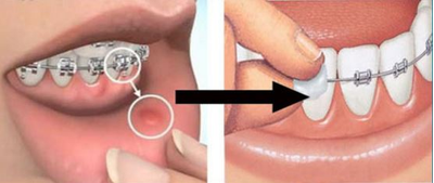 Воск ортодонтический в полосках, PresiDENT, 7 шт. (модификация 1)