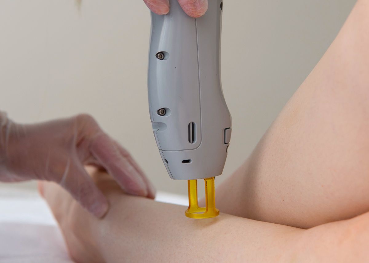 Лазерная эпиляция Кандела в Cicada Clinic - Аппарат Кандела охлаждает кожу перед вспышкой