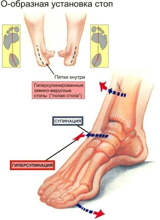 Деформация по типу высокой (полой) стопы.