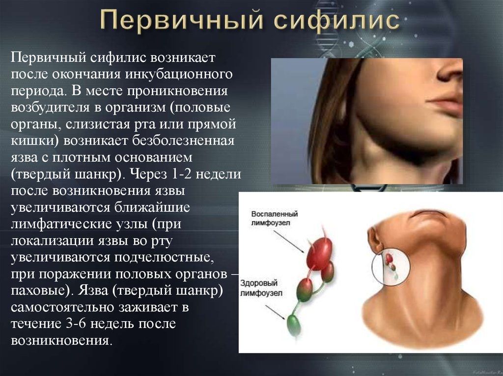 Как выглядит шанкр фото