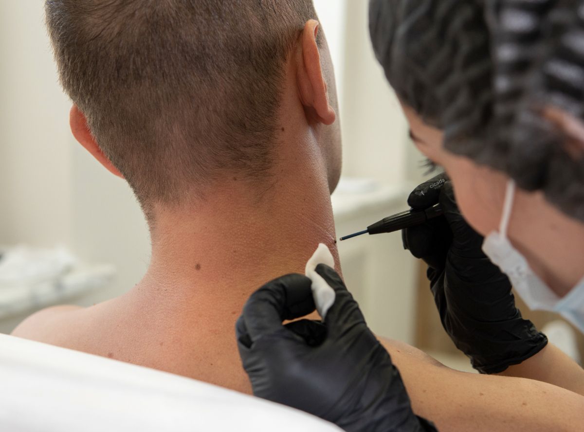 Удаление новообразований на коже Сургитроном в Твери в Cicada Clinic