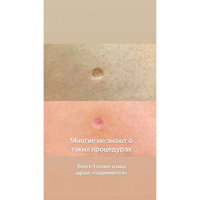 Ремувер с гликолевой кислотой 11% (GLYCOLIC ACID REMOVER) AS Company, 6 мл