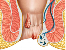 Лечение геморроя