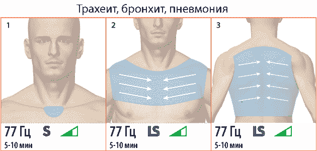 Основные зоны при пневмонии. ДЭНАС ПКМ [НЕЙРОДЭНС] 