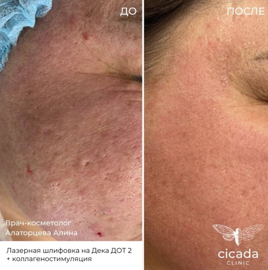 Записаться на процедуру Лазерная шлифовка - в Cicada Clinic