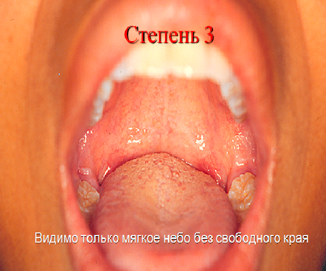 Аденоиды 3 степени фото рентген