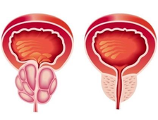 Лечение аденомы предстательной железы