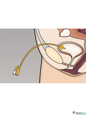 Катетер Фолея двухходовой, латексный Zhanjiang Star, Ch/Fr 10, объем баллона 3-5 мл (Китай)