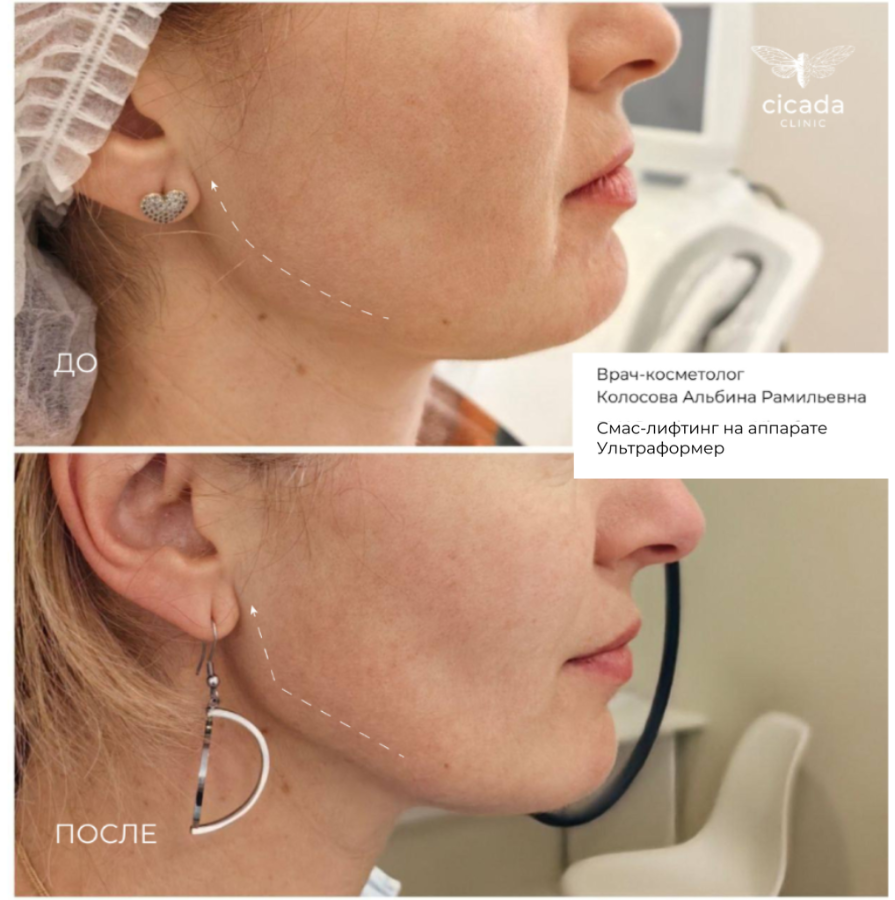 смас лифтинг результат