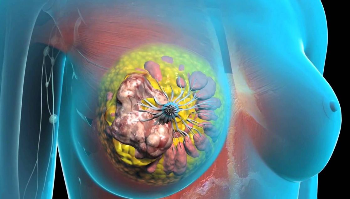Мастопатия молочной железы.