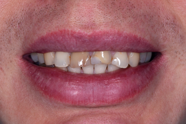 Прямая реставрация фронтальных зубов