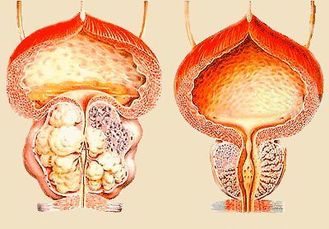 Лечение аденомы простаты