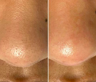 Dermaflash DERMAPORE+ Ultrasonic Pore Extractor - Ультразвуковое устройство для очищения кожи