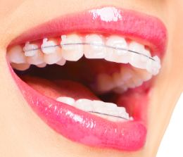 Сапфировые, керамические брекеты. Виды брекетов, выбрать