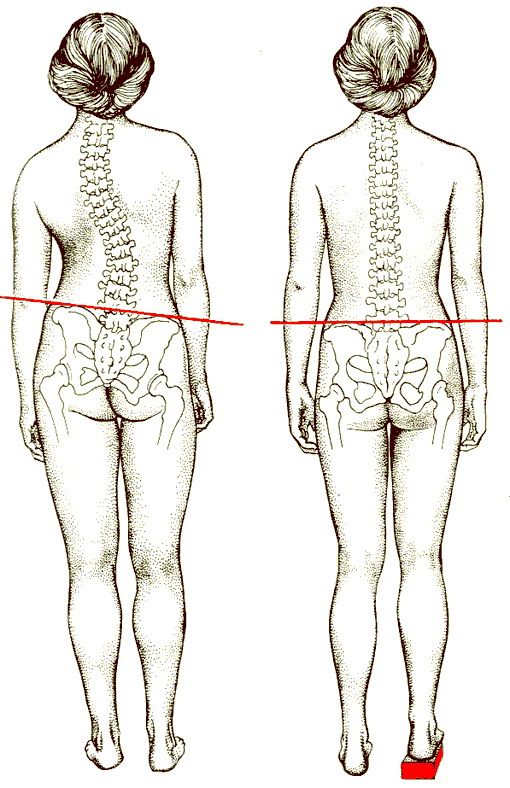 Длин поясница. Искривление позвоночника сколиоз. Искривление позвоночника перекос таза. Перекос позвоночника сколиоз. Перекос (смещение) костей таза.
