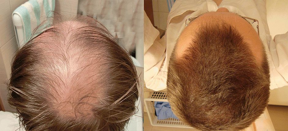 Как ускорить рост волос мужчине на голове. Алерана миноксидил 5. Миноксидил алерана эффект. Алерана миноксидил 5% до и после.