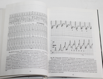 Ардышев А.В. Трепетание предсердий: клиническая электрофизиология и катетерная абляция. М.: ГВКТ им. Н.Н. Бурденко. 2001.