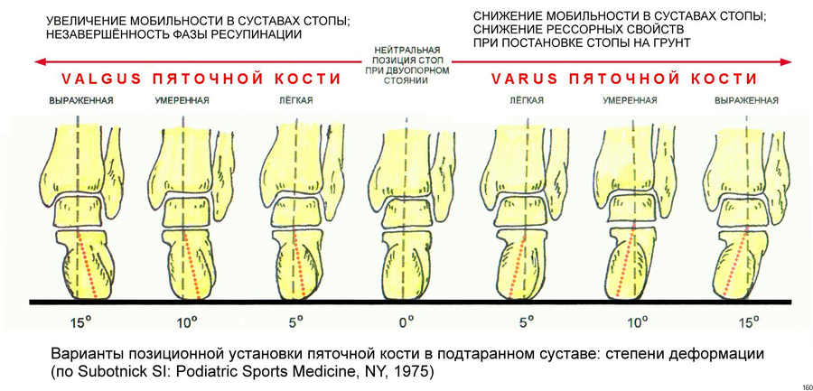 плоско вальгусная деформация стопы операция. стопы плоскостопие вальгус. вальгусная и варусная деформация ног. вальгусная деформация и варусная деформация. продольное плоскостопие схема.