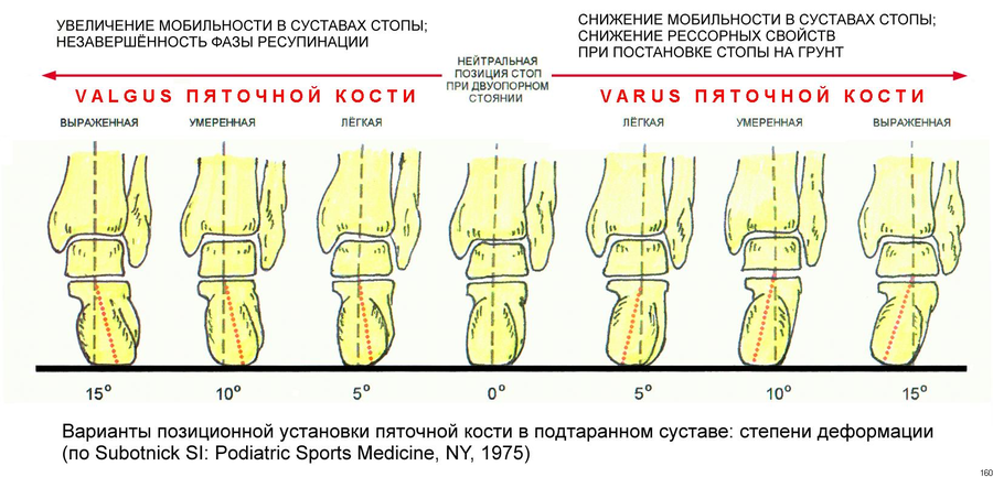 Правильная форма члена. Вальгусная деформация стопы у детей по степеням. Вальгусная деформация голеностопного сустава рентген описание. Вальгусная деформация стопы норма. Классификация вальгусной деформации 1 пальца стопы.