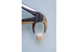 Удаление зуба