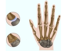 Лечение суставов пальцев рук