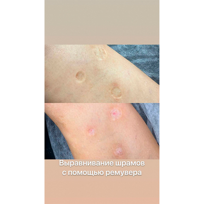 Ремувер с гликолевой кислотой 11% (GLYCOLIC ACID REMOVER) AS Company, 6 мл