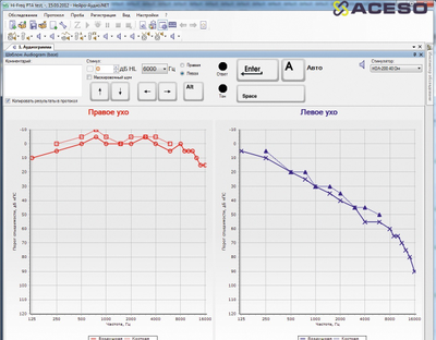 Нейро-Аудио/СВП 2-канальный прибор для проведения объективной аудиометрии (КСВП)