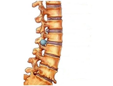 Лечение остеохондроза позвоночника