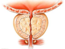 Лечение простаты