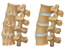 Лечение артроза позвоночника