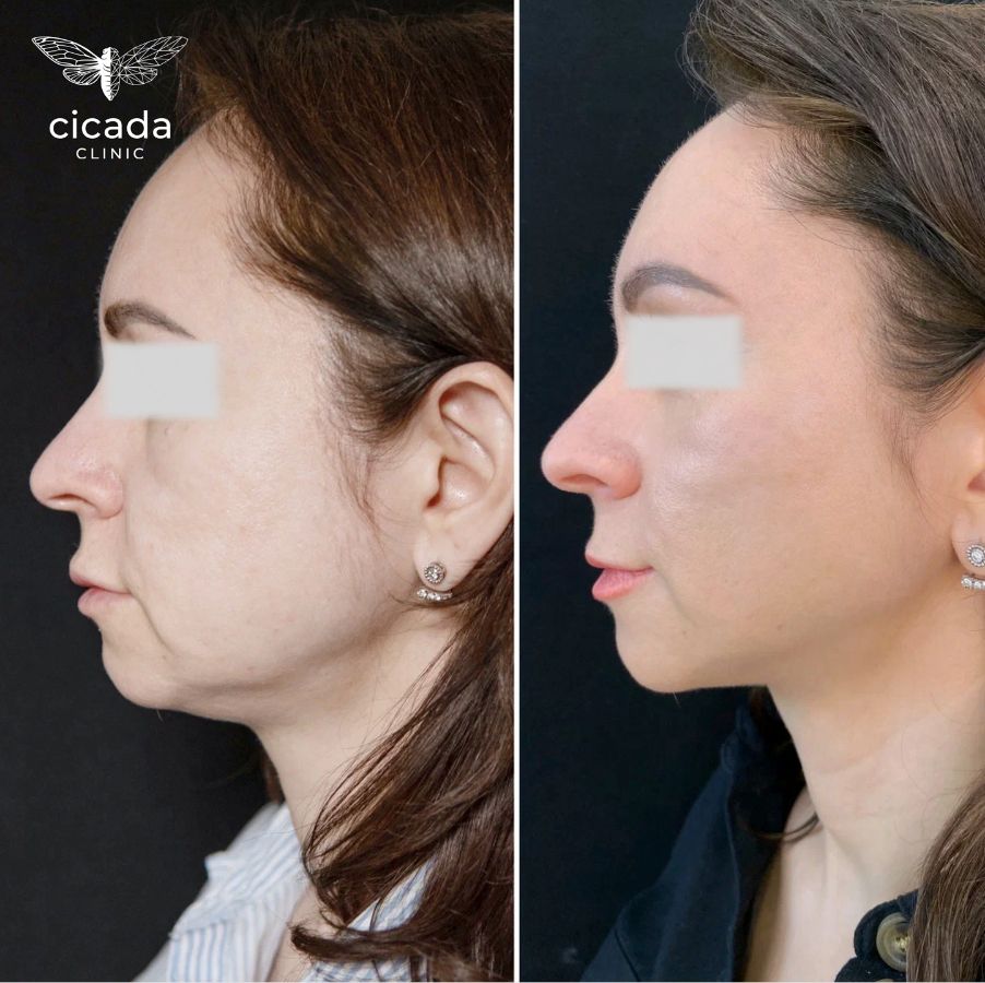 Нитевой лифтинг APTOS Cicada Clinic