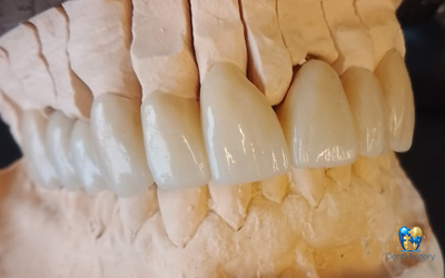 YUCERA UT Multilayer - Идеальный выбор для реставраций передних зубов