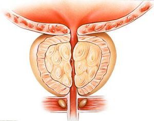 Лечение простаты