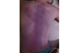 Магнитные банки аккупункционного действия и комплексные банки