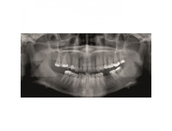 Gendex GXDP-300™ - Цифровая панорамная рентгенодиагностическая система | KAVO DENTAL (Германия)