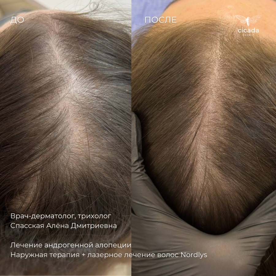 Результат процедуры - Мезотерапия волосистой части головы Cicada Clinic в Твери