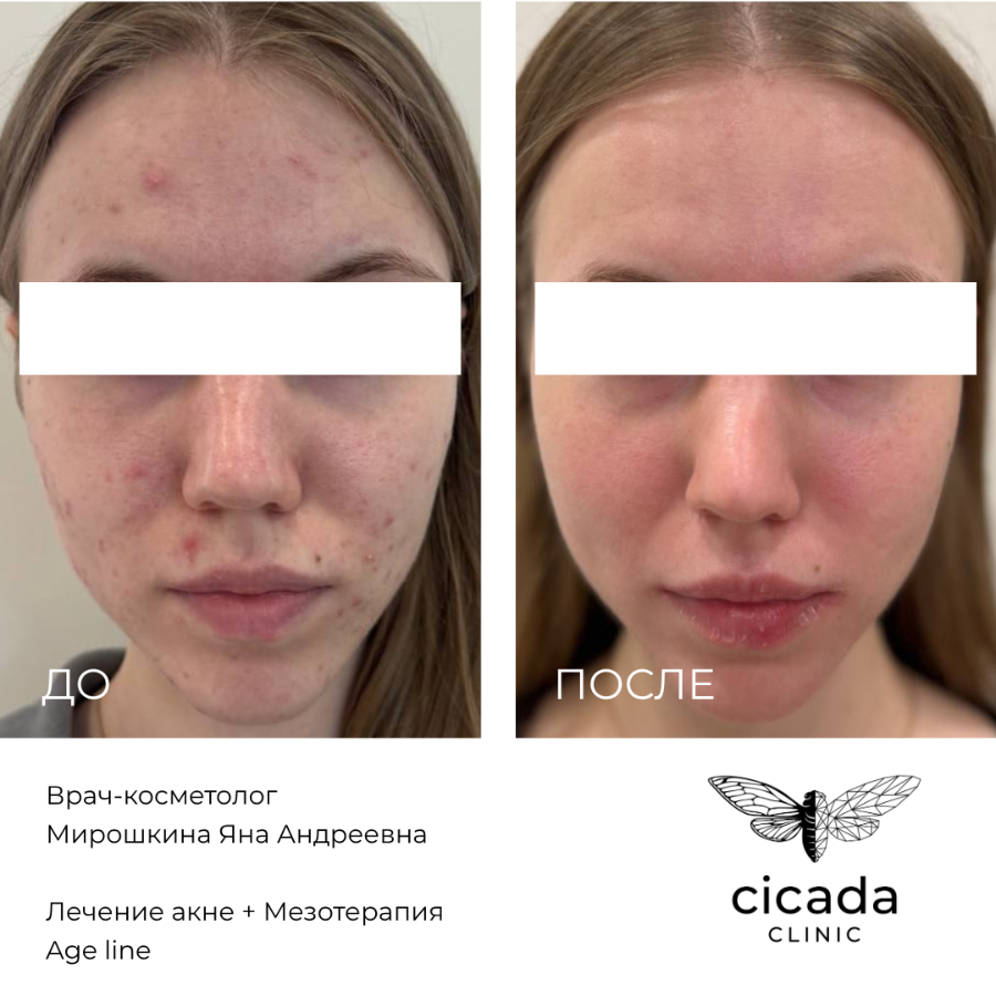 Результат процедуры - Инъекционная мезотерапия в Цикада Клиник 