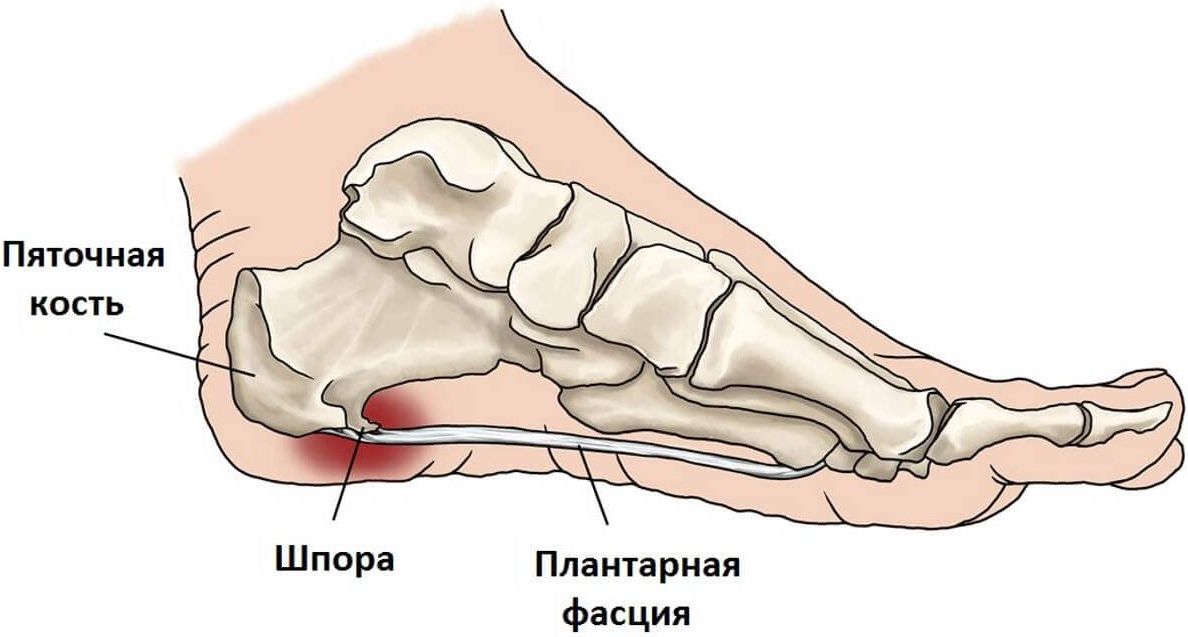 Пяточная шпора - схема 