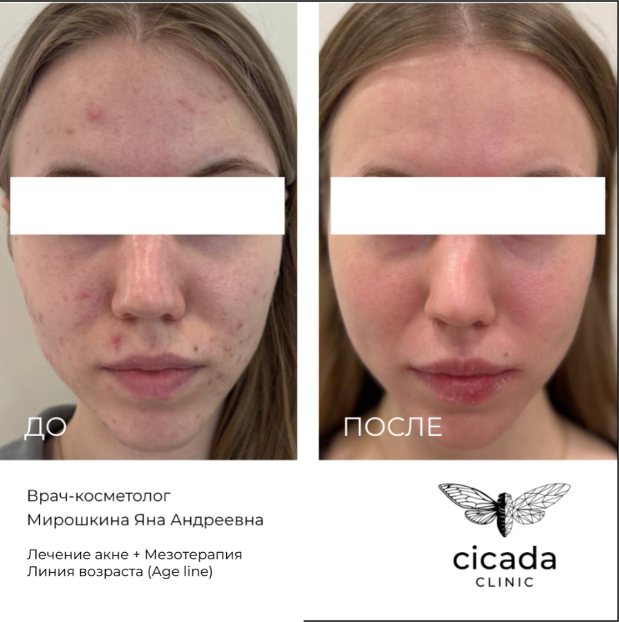 Результат процедуры - Инъекционная мезотерапия в Цикада Клиник 