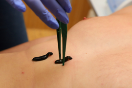 Гирудооздоровление