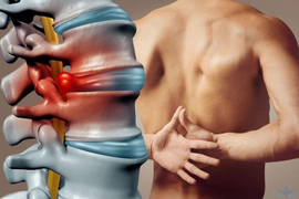 Грыжа поясничного отдела