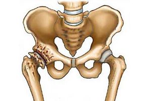 Лечение коксартроза тазобедренного сустава