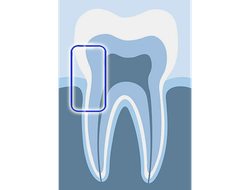Насадки для удаления зубных отложений к ультразвуковым скалерам Varios NSK
