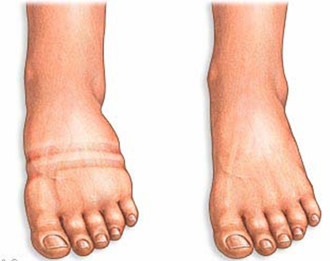 Лечение отёков ног :: стоп, коленей, щиколоток